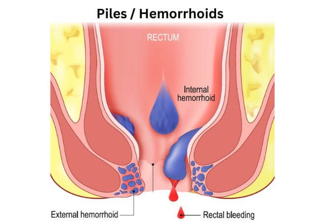 Hemorrhoid Illustration