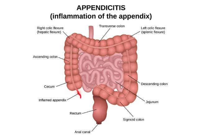 Illustration of appendicitis