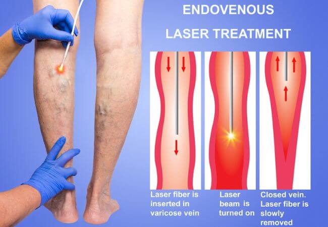 Laser Treatment for Varicose veins in Bangalore