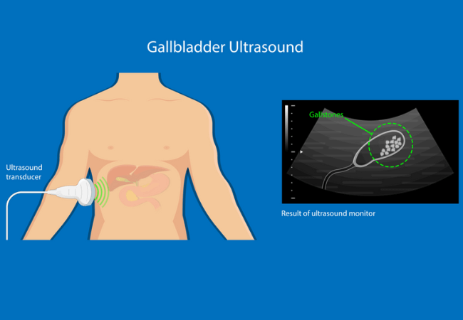 Ultrasound for gallstone diagnosis