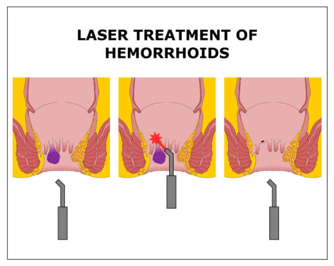 Laser Surgery for Piles / Hemorrhoids in Bangalore
