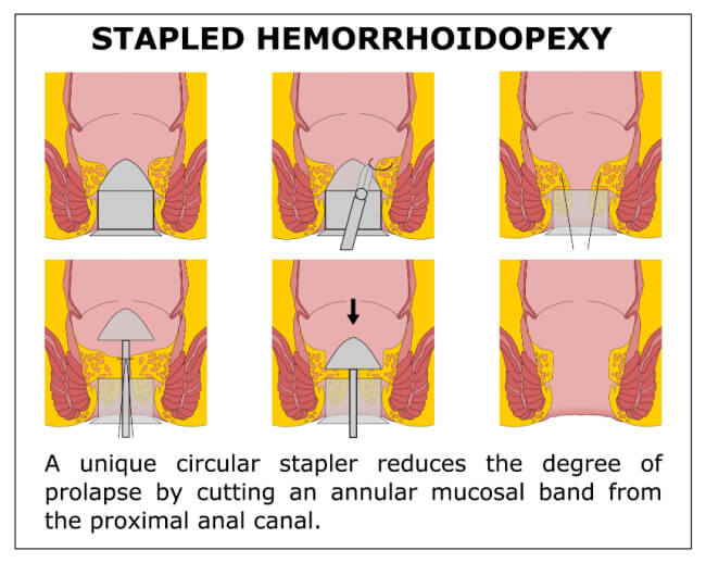 Stapler Surgery for Piles / Hemorrhoids in Bangalore