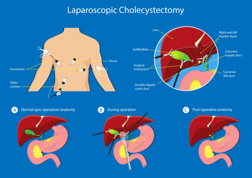 Laparoscopic Gallstone surgery