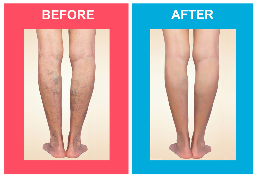 Treatment Of Varicose Before And After. Varicose Veins On The Legs.