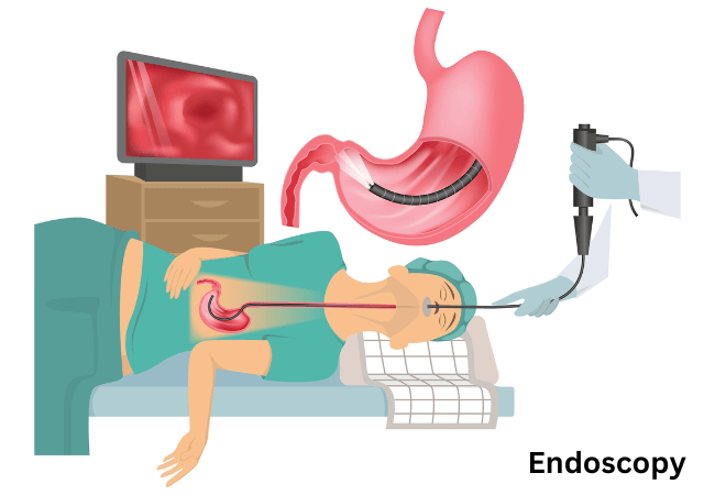 Endoscopy Illustration