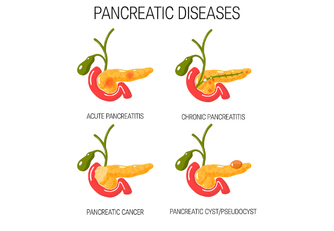 Pancreatic Diseases Bigstoc