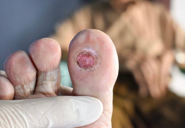 Diabetic Foot Cnv