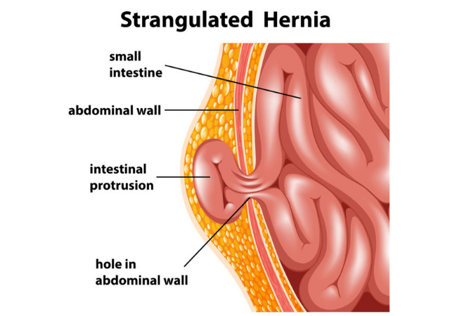 Hernia Cnv 1