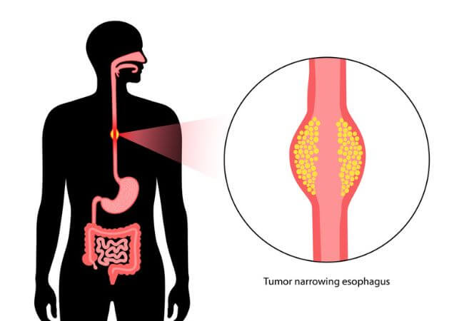 Esophageal Cancer